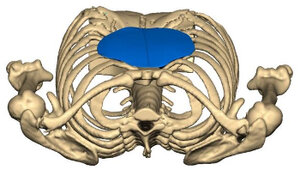 Implantat Trichterbrust