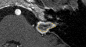 Pseudo-Wachstum des Akustikusneurinoms nach erfolgter Behandlung mit dem Cyberknife