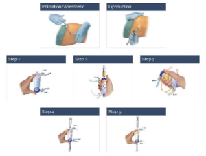 Herstellung von AMFAT mit Lipogems