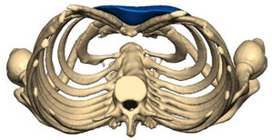 Trichterbrust mit Implantat