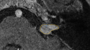 Markiertes Akustikusneurinom vor der Behandlung