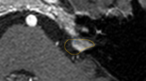 Geschrumpftes Akustikusneurinom nach erfolgreicher Behandlung mit dem Cyberknife