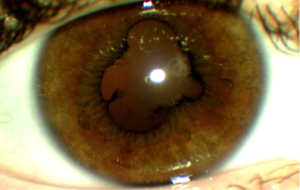 Anteriore Uveitis mit Irissynechien und behindertem Funduseinblick