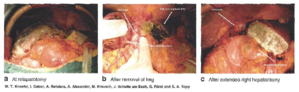 Leberkrebs-Hepatectomy