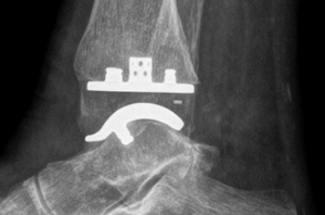 Behandlung mit einer OSG-Totalprothese