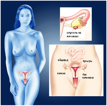 Рак яичников — симптомы, диагностика и лечение в GMS Hospital